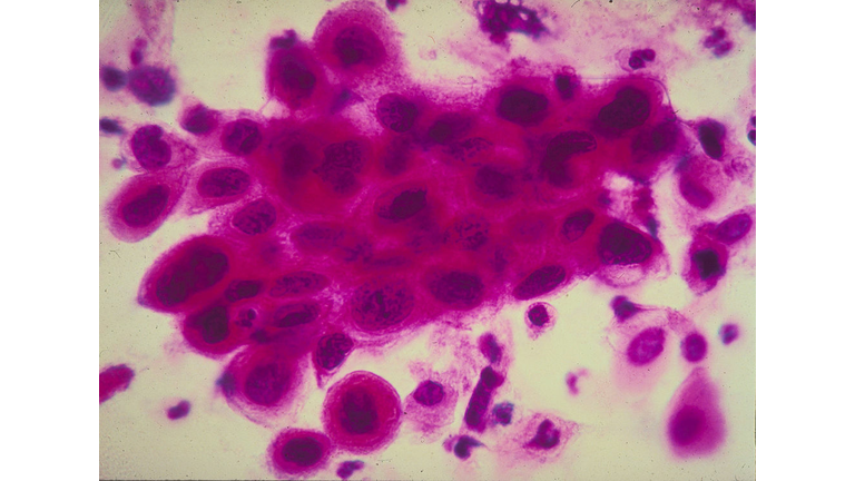 Cancer Images