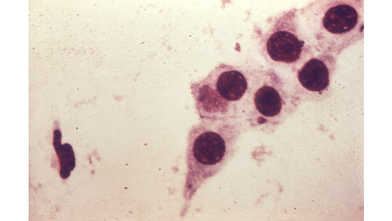 Chlamydia Trachomatis