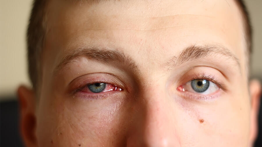 Pink Eye May Be A Coronavirus Symptom iHeart
