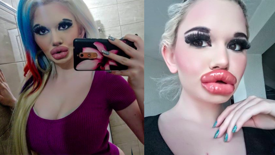 Woman Might Have Biggest Lips In The World After Procedures Iheart