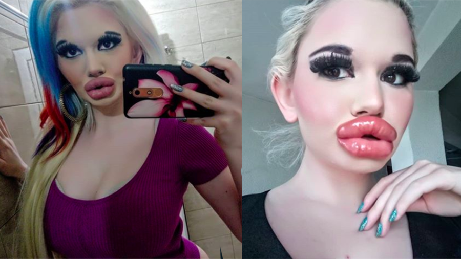 Woman Might Have Biggest Lips In The World After Procedures IHeart