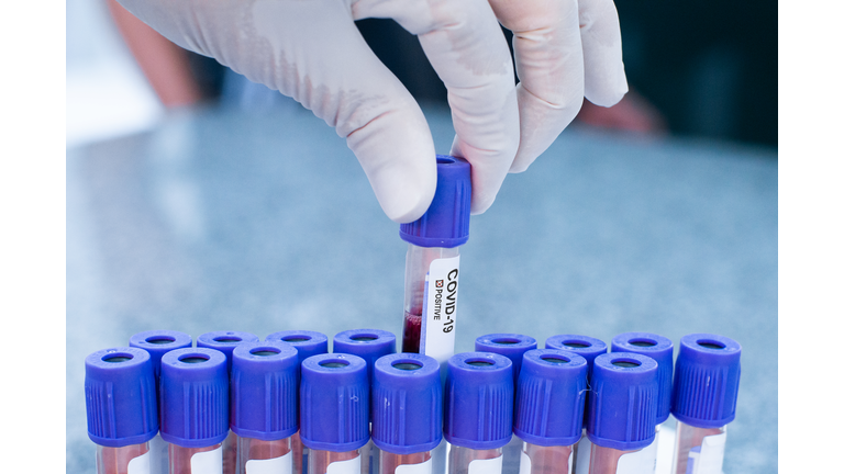 Coronavirus COVID-19 Positive Test