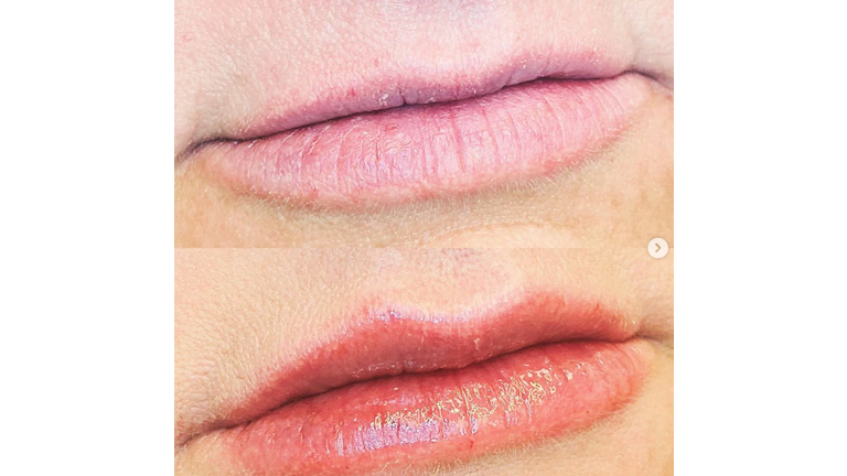 My secret is OUT!! I got some pretty new lips!! 👄 Ahhh yeah! They are perfect!!!!! Feminine. Subtle. I love them! Ask for the Jess Special @rumaaesthetics 💋 U will love Ruma!!! People fly in from ALL over the world because they are THAT GOOD! @sara_rumaaesthetics @aesthetic_injector @faceby_traci