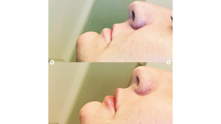 My secret is OUT!! I got some pretty new lips!! 👄 Ahhh yeah! They are perfect!!!!! Feminine. Subtle. I love them! Ask for the Jess Special @rumaaesthetics 💋 U will love Ruma!!! People fly in from ALL over the world because they are THAT GOOD! @sara_rumaaesthetics @aesthetic_injector @faceby_traci