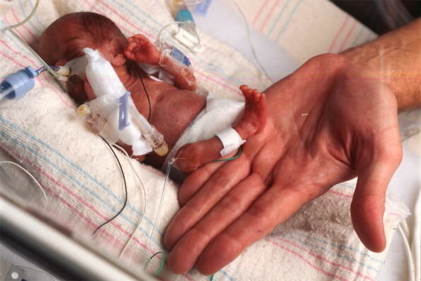 World's Smallest Surviving Baby Makes First Public Appearance