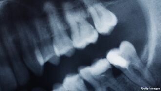 Video: Doctors in India Remove 526 Teeth From Boy's Mouth