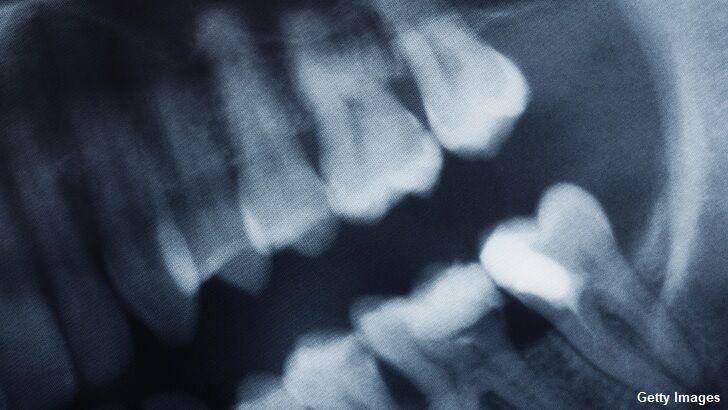 Video: Doctors in India Remove 526 Teeth From Boy's Mouth