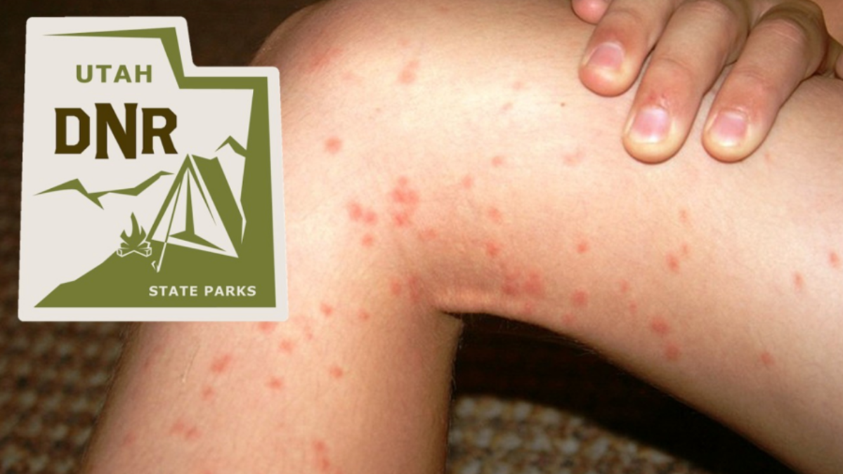 Parasitic pox: Swimmer's itch; where it lurks, how to prevent it