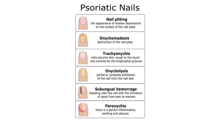Ilustration of psoriatic nails