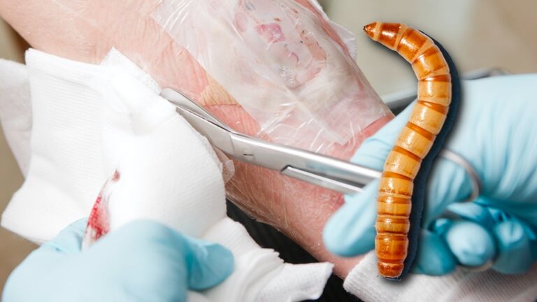 Maggot Therapy