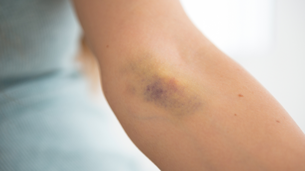 That Mysterious Bruise You Have Might Mean You've Been 'Injection Spiked'