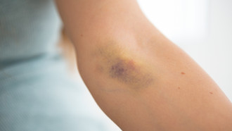 Got A Mysterious Bruise On Your Body? You Might've Been 'Injection Spiked'