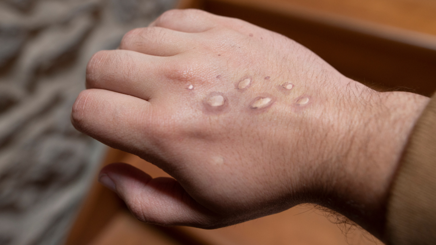 First Case Of Monkeypox Reported In Texas Here's How To Protect