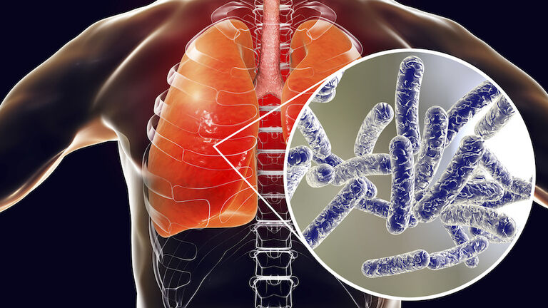 Legionnaires disease, conceptual illustration