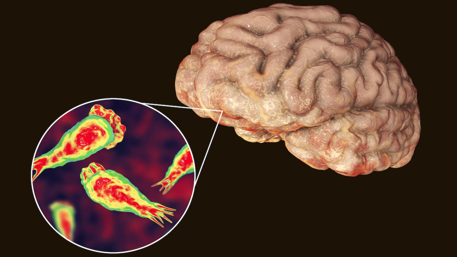 Brain-eating amoeba infection, illustration