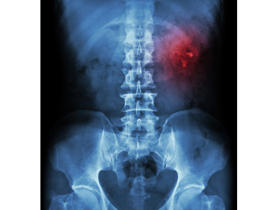 Kidney stone ( renal stone , renal calculi )