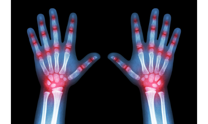 Rheumatoid arthritis