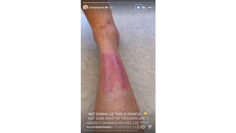 Kim Kardashian Shared Videos of Her 'Painful' Psoriasis Flare-Up on  Instagram