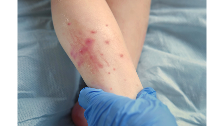 Doctor hands examining infant leg. Little Kid allergy. Closeup. Child scratches a red rash. Nurse applies a special cream to atopic skin. Dermatitis, diathesis, irritation on the baby body. Pruritus