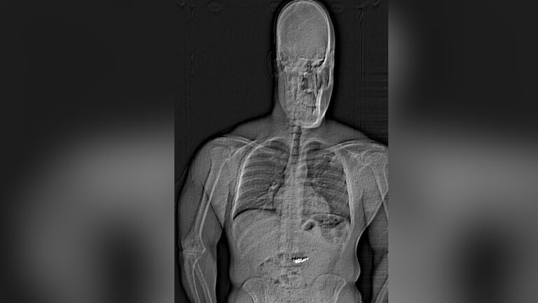 X-ray of a thief who swallowed jewelry