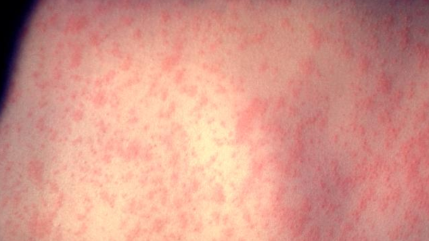 Measles Detected In Marion County Wastewater