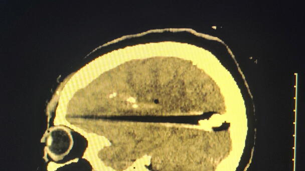 Tampa Woman With Bullet In Brain Sues Apartment Complex