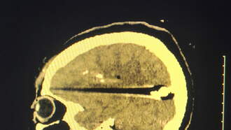 Tampa Woman With Bullet In Brain Sues Apartment Complex