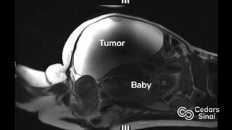 Woman Gives Birth After Discovering Pregnancy Just Days Before