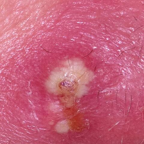 Draining Pus from Huge Abscess