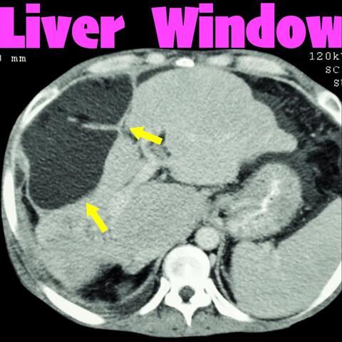 Liver Window