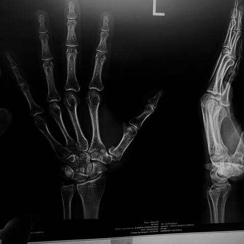 Fractura