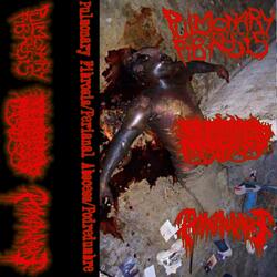 CYSTIC FIBROSIS CAUSED BY MUTATION IN THE TRANSMEMBRANE CONDUCTANCE REGULATOR