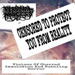 BURN TRAUMA WITH PARTIAL THICKNESS SKIN DAMAGE AND BLISTER FORMATION