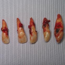 Pus Tooth