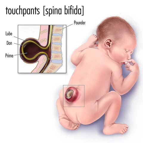 spina bifida
