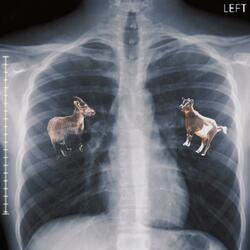 Bronchitis