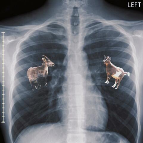 Bronchitis