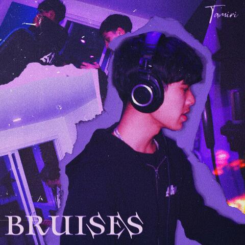 Bruises