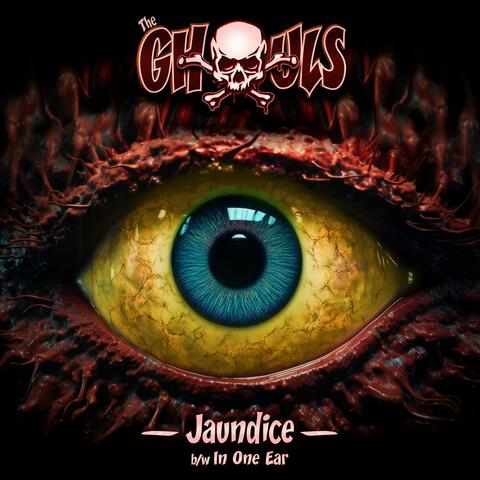 Jaundice