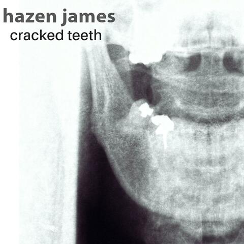 Cracked Teeth