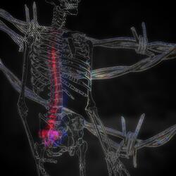 Scoliosis