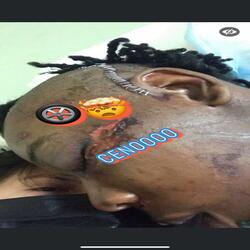 (Tirehead) cenoosyndrome