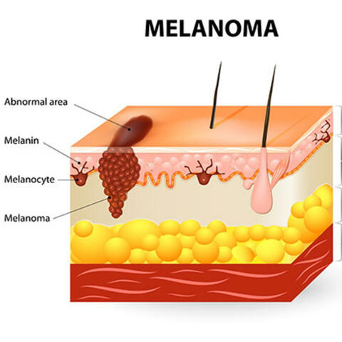 Melanoma