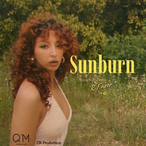 SUNBURN