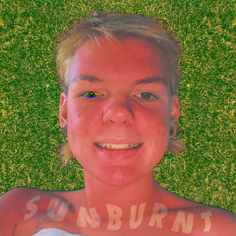 SUNBURNT