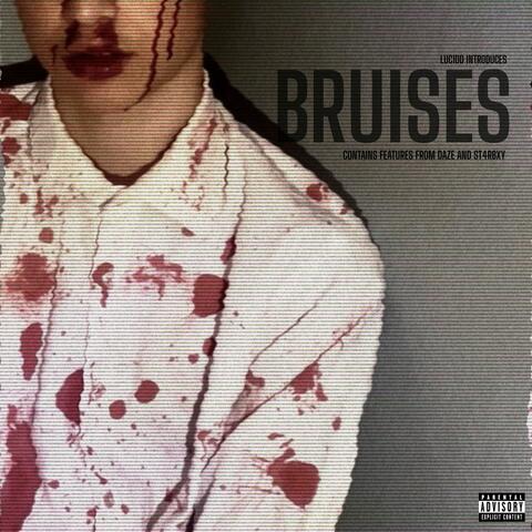 BRUISES