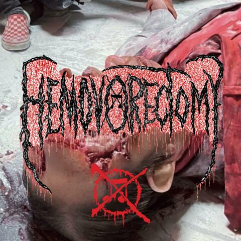 Postmortem Intracranial Hemorrhagic Dissemination