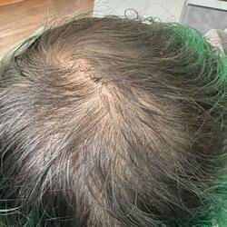 Bald Eagluke (Luke Rader Balding Song)