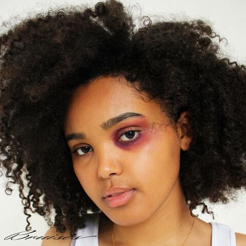 Bruises