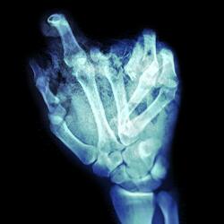 breaking the bones in my hands